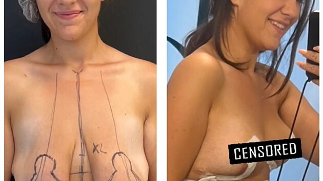 Barbora Dem�terov� podstoupila modelaci prsou. (srpen 2025)