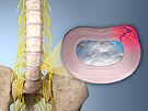 Vyh�ezlá meziobratlová ploténka neboli disk. P�i po�kození ploténky se vnit�ní...