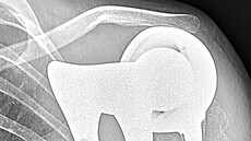 Rentgenový snímek lopatky vytitné pomocí 3D tisku