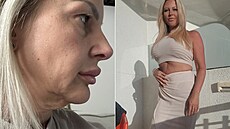 Plastika byla po extrémním úbytku váhy jediným eniným eením.