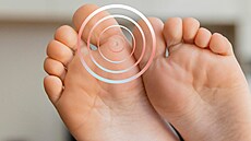 Bradavice � nevinn� vypadající výr�stky, které doká�ou potrápit