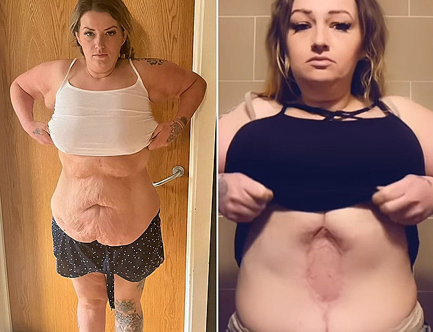 Po plastice břicha nastaly komplikace, žena zůstala zohyzděná