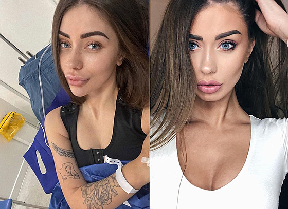 Kráska lituje toho, e si v minulosti augmentaci prsou nechala udlat.