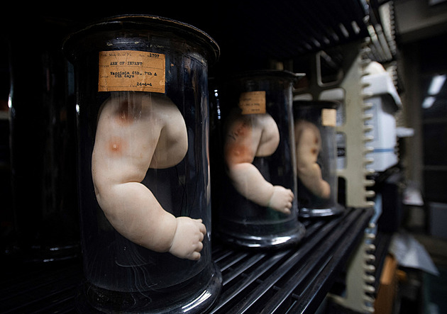 Mütterovo muzeum ve Filadelfii stojí mezi vědou a kuriozitami medicíny