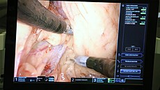 Operace s robotickou asistencí ve 3D obraze