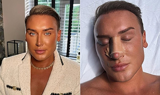 P�es sto invazivních zákrok� v obli�eji má za sebou mu� posedlý vlastním...