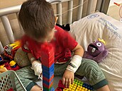 Oliver utrpl popáleniny druhého stupn.