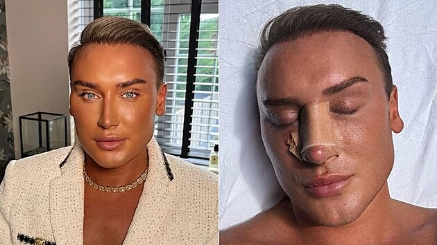 P�es sto invazivn�ch z�krok� v obli�eji m� za sebou mu� posedl� vlastn�m vzhledem. Prahne po dokonal� kr�se a jde si za sv�m snem. Nyn� je �as i na dal�� ��sti t�la, kter� si je�t� nenechal upravit.