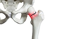 Místo, kde dlouhá stehenní kost pechází v kloubní hlavici kyelního kloubu,...