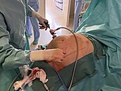 Tomá Paseka, pedseda herniologické sekce eské chirurgické spolenosti a...