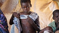 Ibrahim Ismail, který utrp�l zran�ní p�i útoku RSF na trh v západosúdánském...