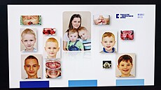 Specializované centrum ve Fakultní nemocnici Brno se v�nuje lé�b� roz�t�pu....