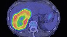 Sekundární karcinom jater - snímek z CT