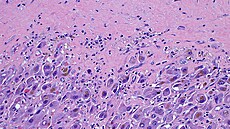 Lé�ený hepatocelulární karcinom - sv�telná mikrofotografie.