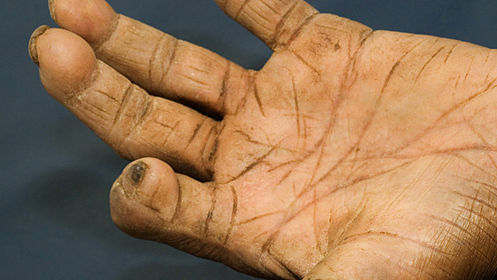 Pacient s leprou (ilustra�ní foto)