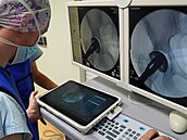 Robot s názvem ROSA, p�ezdívaný R��enka, pomáhá ortoped�m v Mladé Boleslavi u�...