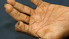 Pacient s leprou (ilustraní foto)