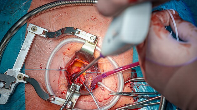 Nov� metoda umo��uje nahradit nemocnou chlope� mal�m �ezem mezi �ebry na prav� stran� hrudn�ku, tedy bez nutnosti klasick�ho otev�en� hrudn� kosti.