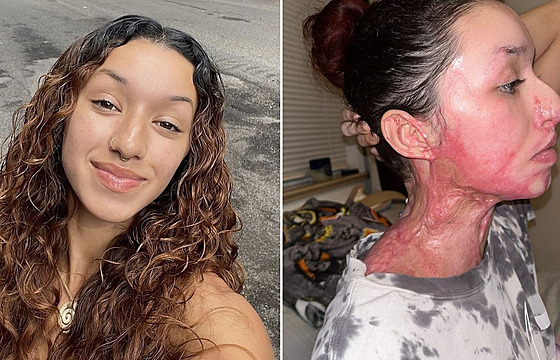 �enu ve fitnes centru polili kyselinou. Má poleptanou polovinu t�la a málem...