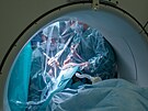 Ve Fakultn� nemocnici Olomouc provedli l�ka�i unik�tn� operaci pacienta...