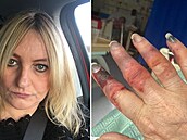 �ena p�i�la o prsty na rukách i nohách.