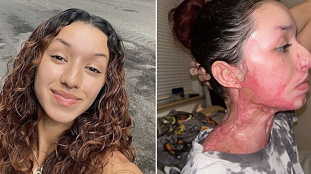 �enu ve fitnes centru polili kyselinou. M� poleptanou polovinu t�la a m�lem nep�e�ila.