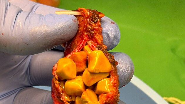 �lu�ov� kameny b�vaj� nej�ast�j��m d�vodem pro odstran�n� �lu�n�ku.