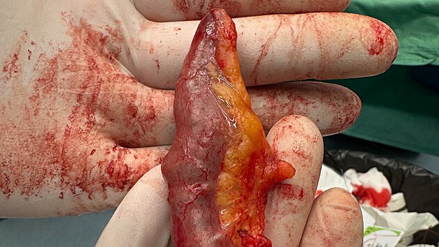 Vyoperovan� slep� st�evo se z�n�tem