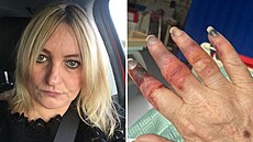 �ena p�i�la o prsty na rukách i nohách.