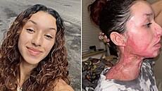 �enu ve fitnes centru polili kyselinou. Má poleptanou polovinu t�la a málem...