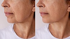 Lifting obli�eje vám pozvedne i sebev�domí