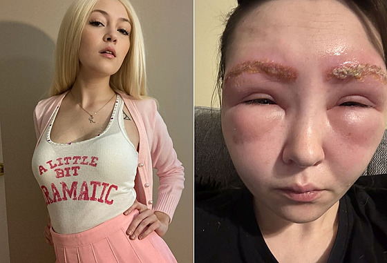 Alergická reakce �enu vyd�sila.