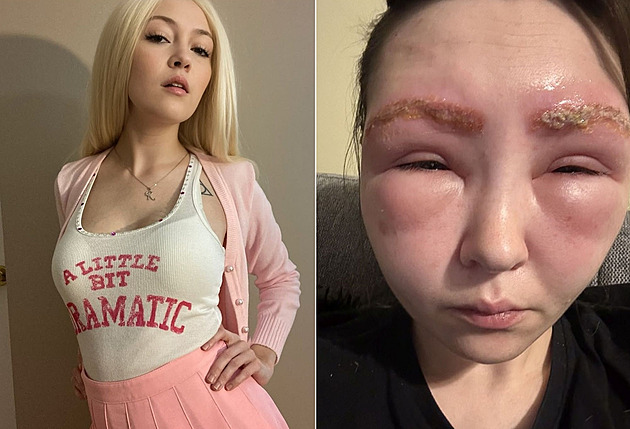 Místo krásného obočí znetvořený obličej. Žena doplatila na kosmetický trend