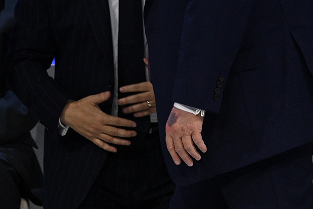 Modřiny i únava jdou stranou? Trump před 80. jubileem hlásí „perfektní formu“