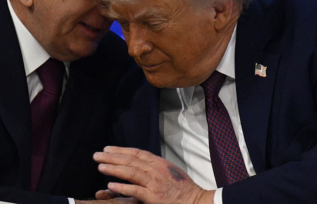 Další kožní problém. Trumpovi se objevila vyrážka na krku, lékař prozradil důvod