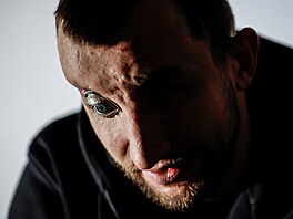 Divadlo veterán�. Zran�ní ukrajin�tí vojáci nazkou�eli v Kyjev� experimentální...