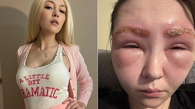 Alergick� reakce �enu vyd�sila.