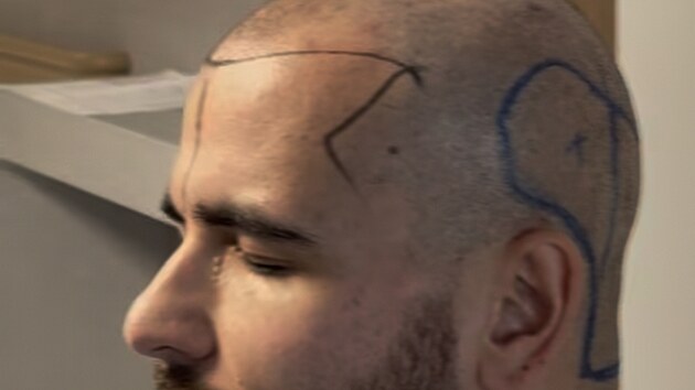 Dominik Vr�ansk� t�sn� p�ed transplantac� vlas�.