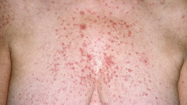 Tak u syndromu zprvu vypad� vyr�ka, ne� se k��e za�ne rozpadat.