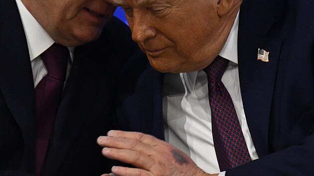 Modřina ve tvaru Grónska? Trump si přivodil novou podlitinu, prozradil jak