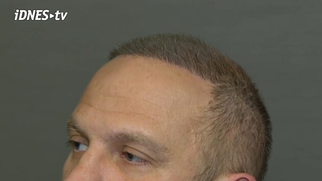 Brat�i Pol�kovi ze skupiny O5 a Rade�ek podstoupili transplantaci vlas�. O z�kroku promluvili v rozhovoru pro iDNES.cz. (leden 2026)