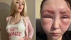 Alergická reakce �enu vyd�sila.