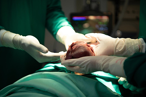 Transplantace srdce, ilustra�ní snímek