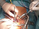 Olomouck� fakultn� nemocnice za�ala p�i operac�ch bypassu vyu��vat robotick�...