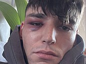 Amatérský rozhod�í utrp�l p�i no�ním útoku zran�ní v oblasti pravého oka. Útok...