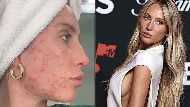 S akn� modelka bojovala n�kolik let.