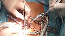 Olomoucká fakultní nemocnice za�ala p�i operacích bypassu vyu�ívat robotický...