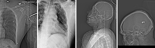 Rentgeny hrůzy. Íránská armáda cíleně střílí demonstrantům do očí a genitálií