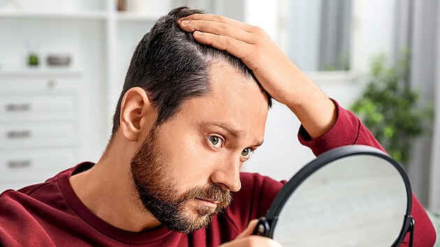 Ple�at�n� neboli alopecie postihuje mnohem v�ce mu�e ne� �eny. A� dv� t�etiny...