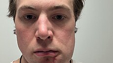 Charlie McAvoy a jeho oteklá tvá� po úderu loktem do obli�eje.